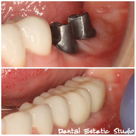 METALNA NADOGRADNJA ZUBNOG IMPLANTATA